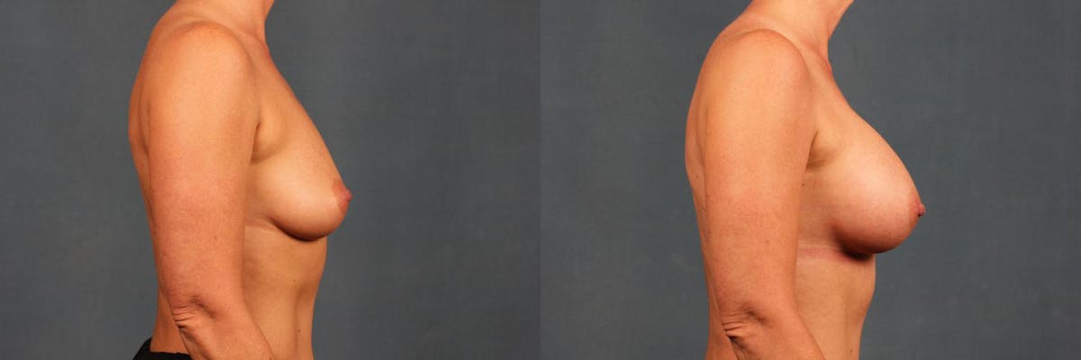 Enlargement - Silicone Before & After Gallery - Patient 263676 - Image 3