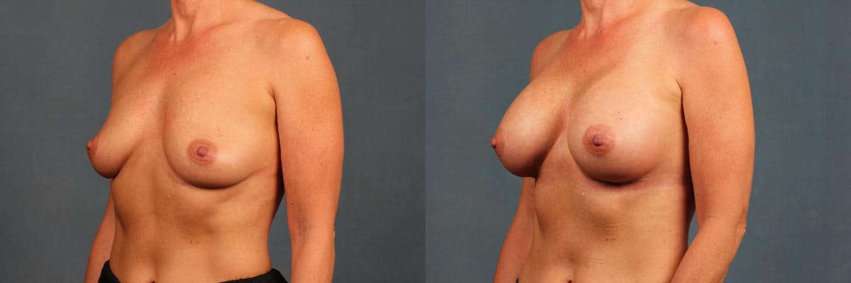 Enlargement - Silicone Before & After Gallery - Patient 263676 - Image 4