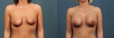 Enlargement - Silicone Before & After Gallery - Patient 405273 - Image 1