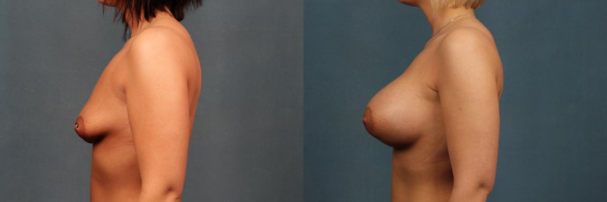 Enlargement - Silicone Before & After Gallery - Patient 405273 - Image 2