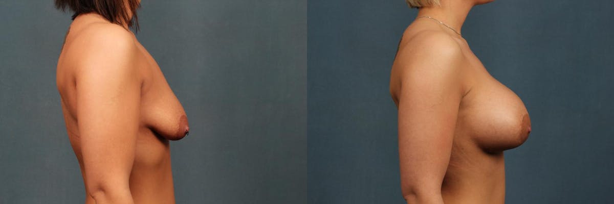 Enlargement - Silicone Before & After Gallery - Patient 405273 - Image 4