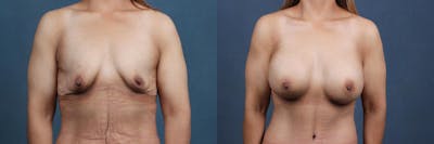 Enlargement - Silicone Before & After Gallery - Patient 381727 - Image 1