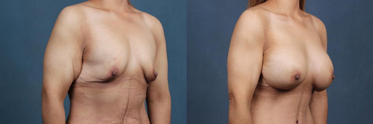Enlargement - Silicone Before & After Gallery - Patient 381727 - Image 2