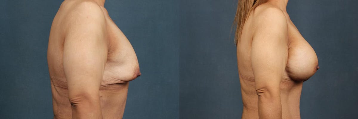 Enlargement - Silicone Before & After Gallery - Patient 381727 - Image 3