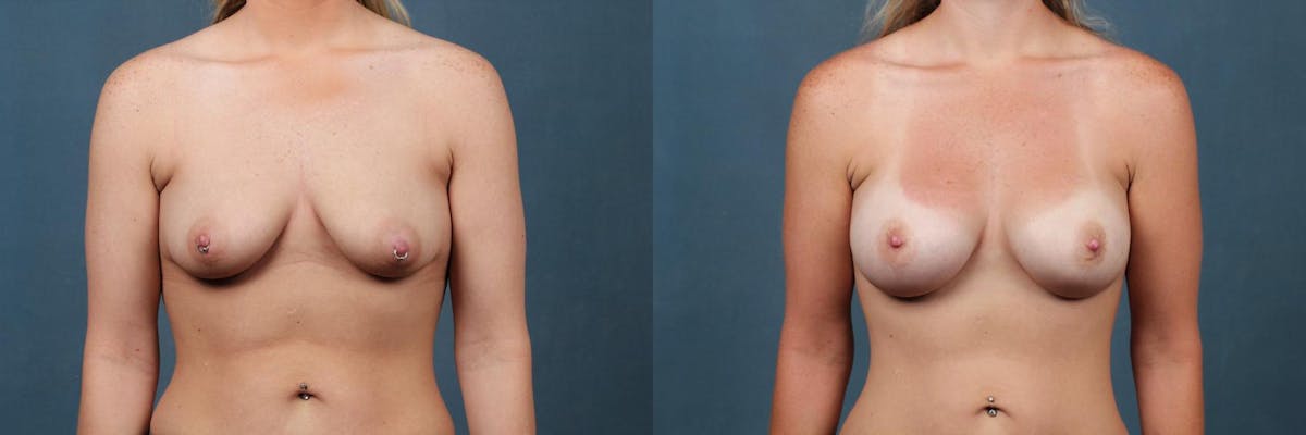 Enlargement - Silicone Before & After Gallery - Patient 394618 - Image 1
