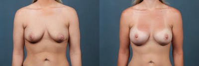 Enlargement - Silicone Before & After Gallery - Patient 394618 - Image 1