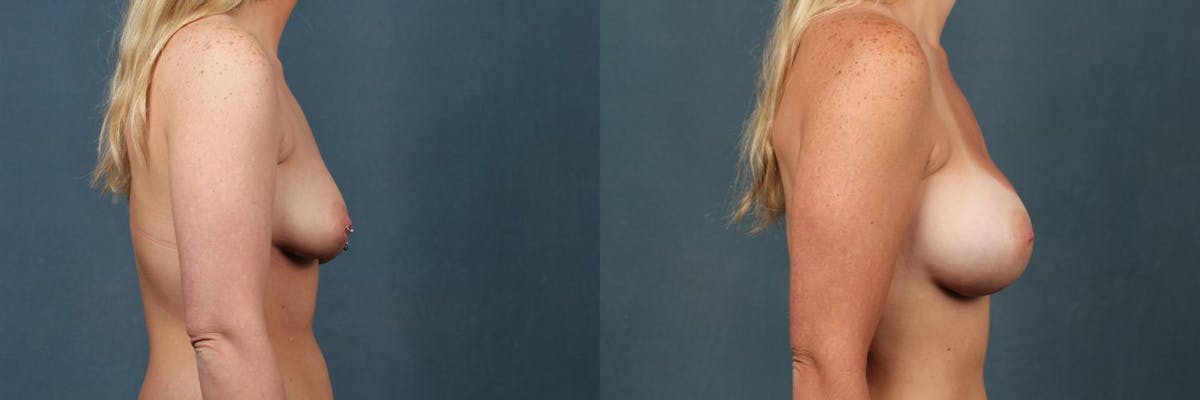 Enlargement - Silicone Before & After Gallery - Patient 394618 - Image 3