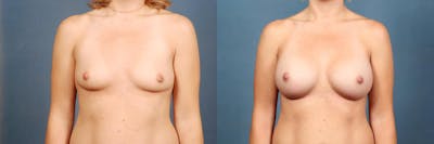 Enlargement - Silicone Before & After Gallery - Patient 221150 - Image 1