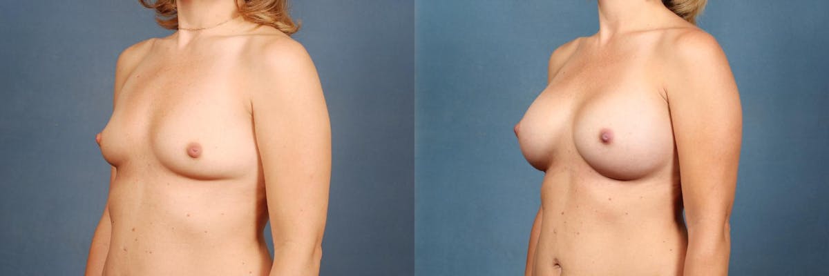 Enlargement - Silicone Before & After Gallery - Patient 221150 - Image 2