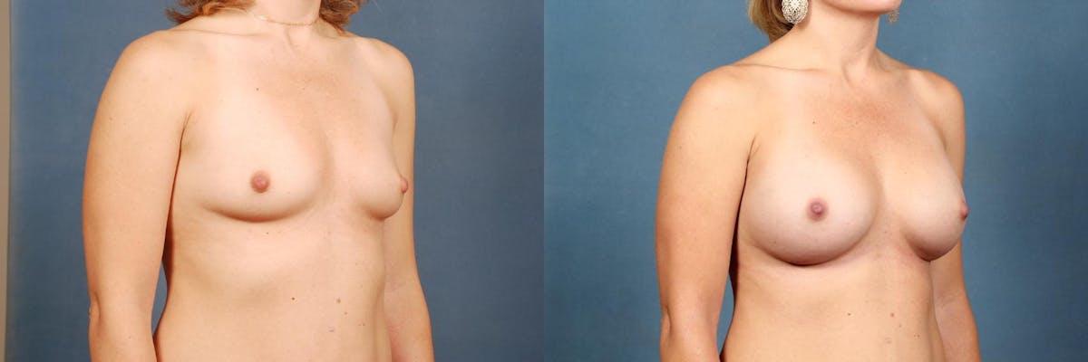 Enlargement - Silicone Before & After Gallery - Patient 221150 - Image 3