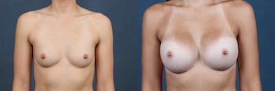 Enlargement - Silicone Before & After Gallery - Patient 223372 - Image 1