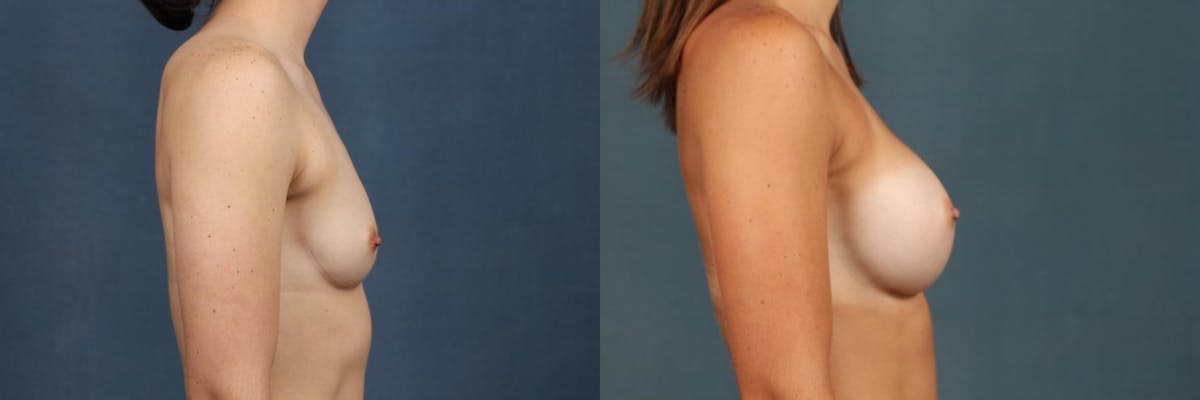 Enlargement - Silicone Before & After Gallery - Patient 223372 - Image 3