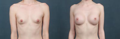 Enlargement - Silicone Before & After Gallery - Patient 313188 - Image 1