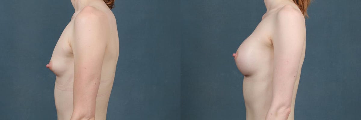 Enlargement - Silicone Before & After Gallery - Patient 313188 - Image 2