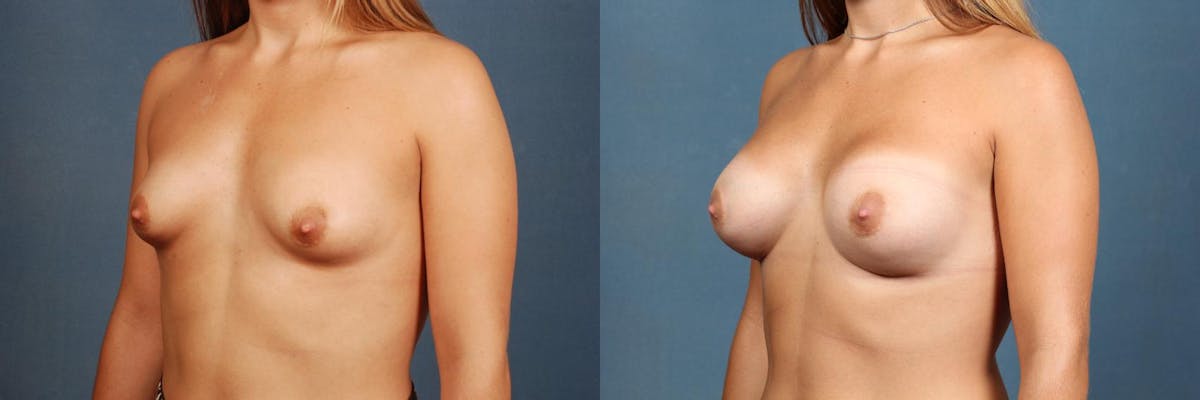 Enlargement - Silicone Before & After Gallery - Patient 314219 - Image 2