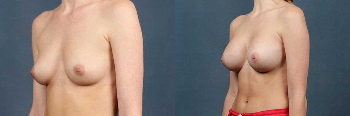 Enlargement - Silicone Before & After Gallery - Patient 142438 - Image 2