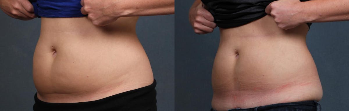 CoolSculpting Before & After Gallery - Patient 342938 - Image 2