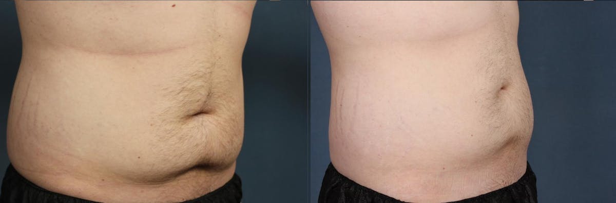 CoolSculpting Before & After Gallery - Patient 200372 - Image 2