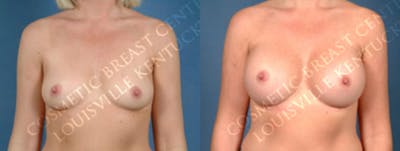 Enlargement - Silicone Before & After Gallery - Patient 175447 - Image 1