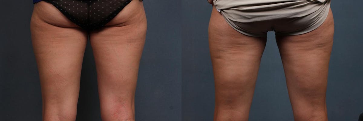 CoolSculpting Before & After Gallery - Patient 281243 - Image 1