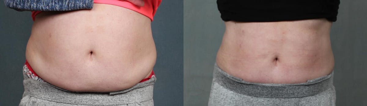 CoolSculpting Before & After Gallery - Patient 378400 - Image 1