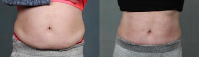 CoolSculpting Before & After Gallery - Patient 378400 - Image 1