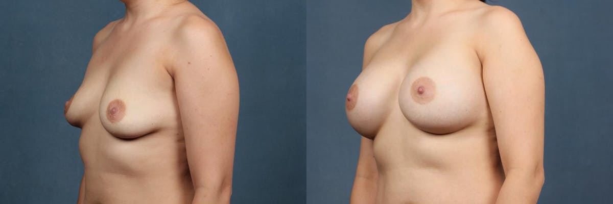 Enlargement - Silicone Before & After Gallery - Patient 167232 - Image 1