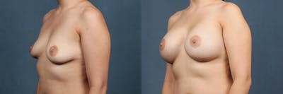 Enlargement - Silicone Before & After Gallery - Patient 167232 - Image 1