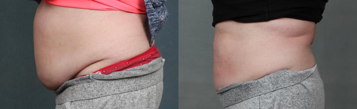 CoolSculpting Before & After Gallery - Patient 378400 - Image 2