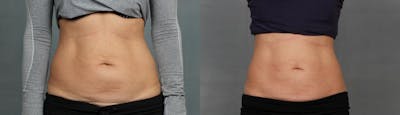 CoolSculpting Before & After Gallery - Patient 655693 - Image 1