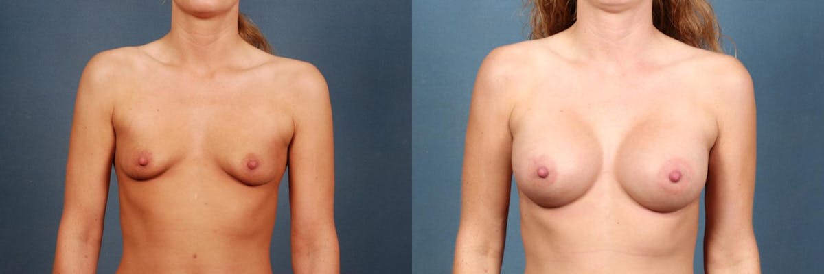 Enlargement - Silicone Before & After Gallery - Patient 184344 - Image 1