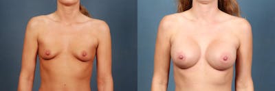 Enlargement - Silicone Before & After Gallery - Patient 184344 - Image 1