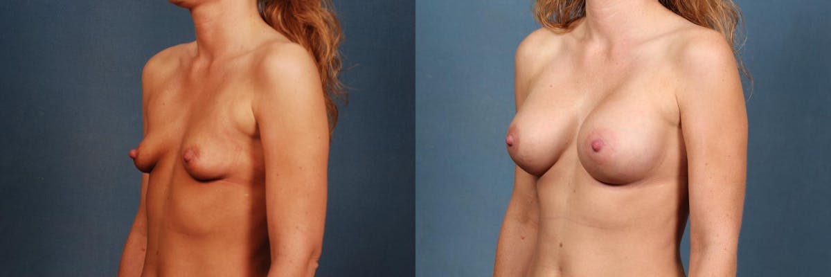 Enlargement - Silicone Before & After Gallery - Patient 184344 - Image 2
