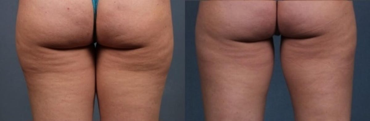 CoolSculpting Before & After Gallery - Patient 165512 - Image 1