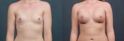 Enlargement - Silicone Before & After Gallery - Patient 369147 - Image 1