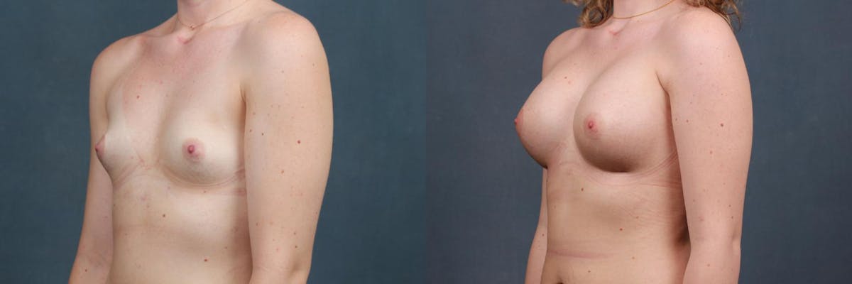 Enlargement - Silicone Before & After Gallery - Patient 369147 - Image 2