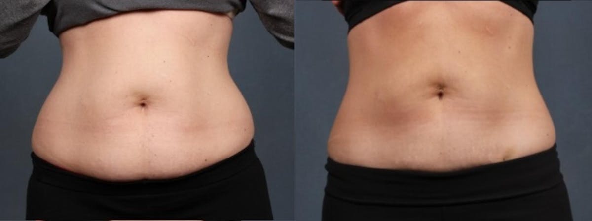 CoolSculpting Before & After Gallery - Patient 135597 - Image 1