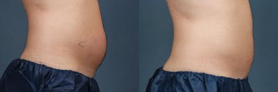 CoolSculpting Before & After Gallery - Patient 355064 - Image 1