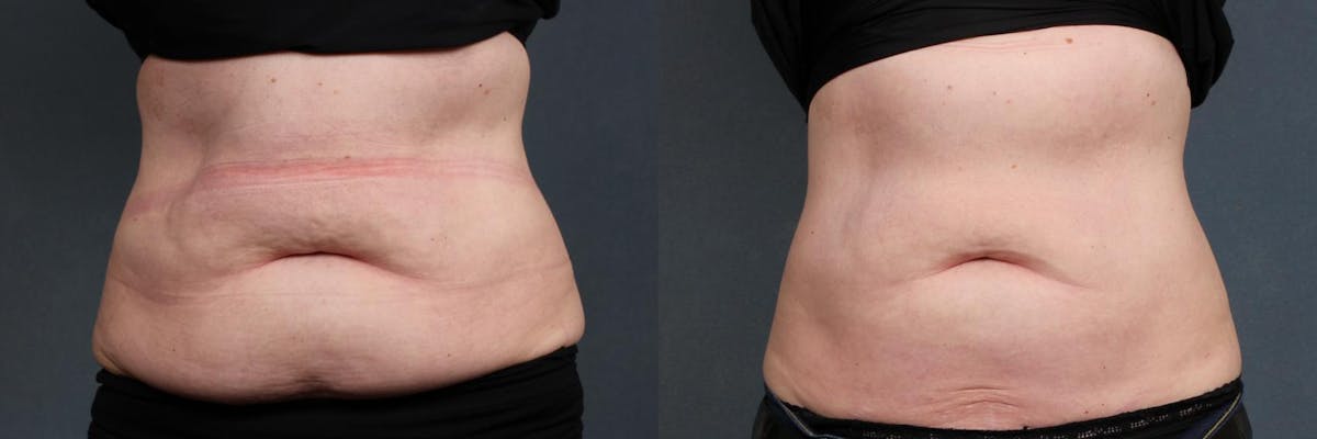 CoolSculpting Before & After Gallery - Patient 313006 - Image 1