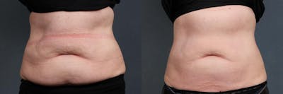 CoolSculpting Before & After Gallery - Patient 313006 - Image 1