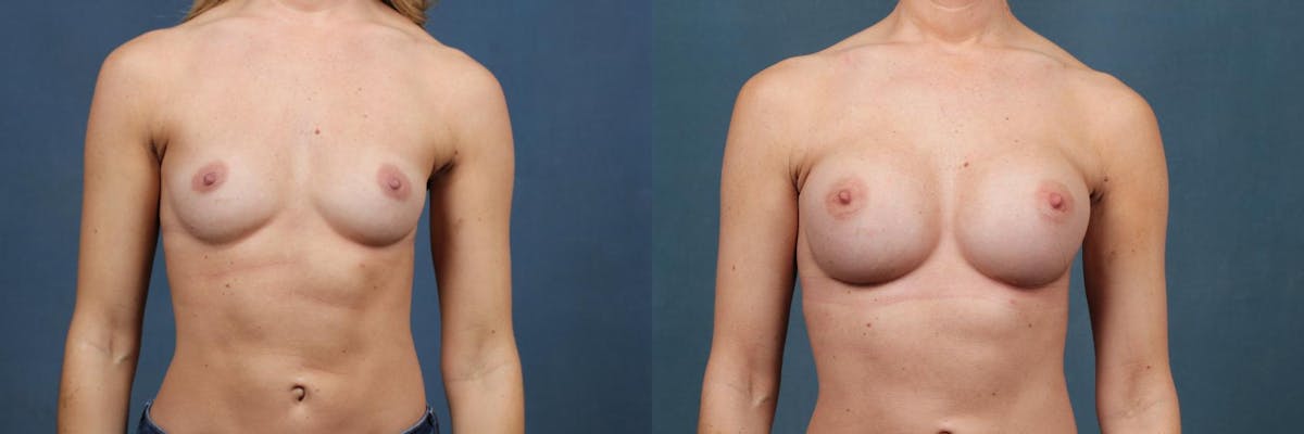 Enlargement - Silicone Before & After Gallery - Patient 395038 - Image 1