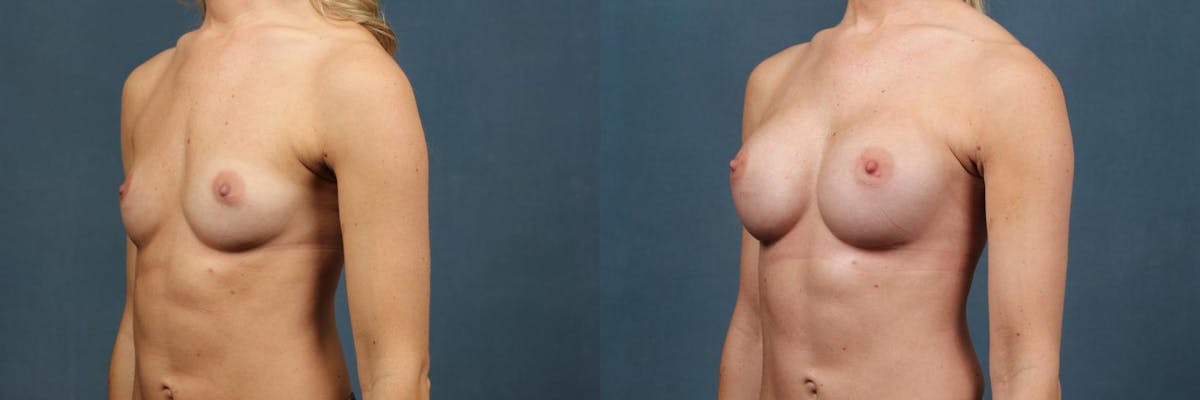 Enlargement - Silicone Before & After Gallery - Patient 395038 - Image 2