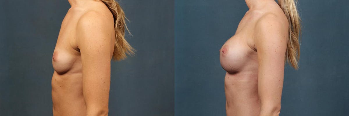 Enlargement - Silicone Before & After Gallery - Patient 395038 - Image 3