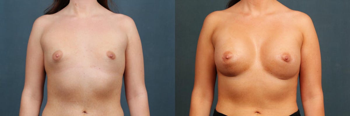 Enlargement - Silicone Before & After Gallery - Patient 399740 - Image 1