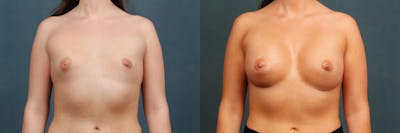 Enlargement - Silicone Before & After Gallery - Patient 399740 - Image 1