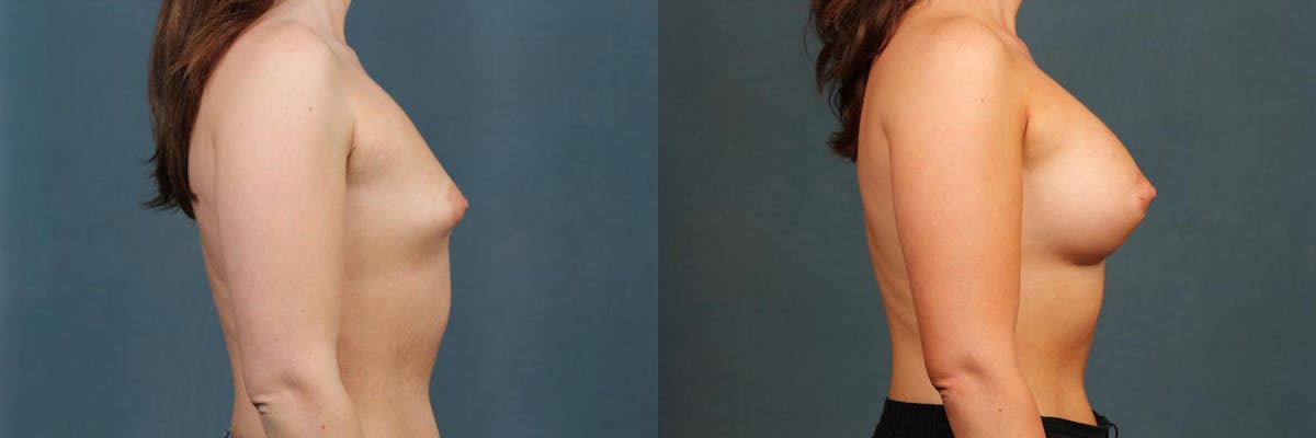Enlargement - Silicone Before & After Gallery - Patient 399740 - Image 3