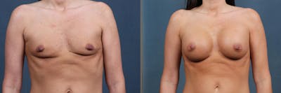 Enlargement - Silicone Before & After Gallery - Patient 905218 - Image 1