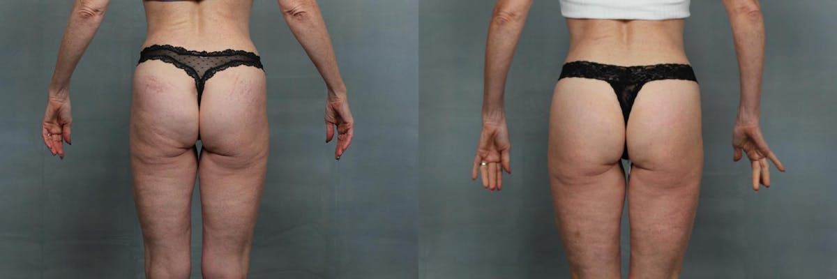 EMSculpt Before & After Gallery - Patient 296290 - Image 1