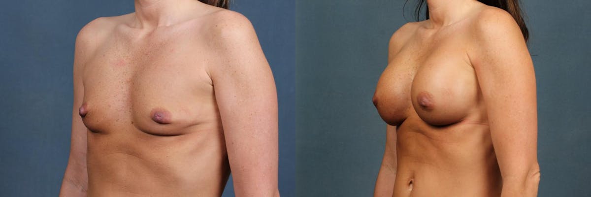 Enlargement - Silicone Before & After Gallery - Patient 905218 - Image 2
