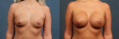 Enlargement - Silicone Before & After Gallery - Patient 157669 - Image 1